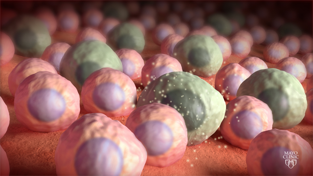 zombie-neurons-identified-in-alzheimers-brains-309765